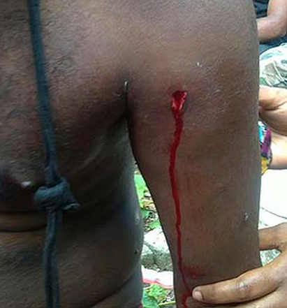 West Papua gunshot wound