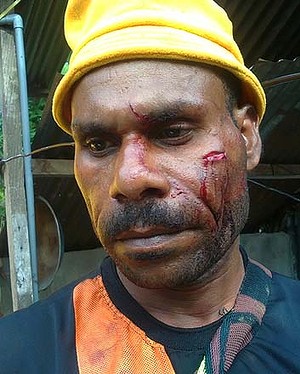 Wounded Papuan